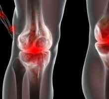Reaktivni artritis: Simptomi in zdravljenje
