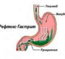 Povratni gastritis: Vzroki, simptomi, zdravljenje