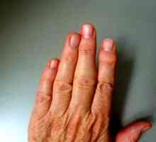 Revmatoidni artritis prstov, prvi simptomi