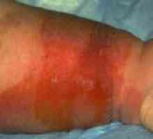 Rdečica spodnji del noge: diagnoza in zdravljenje