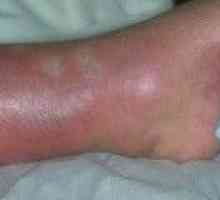 Rdečica noge - simptomi, zdravljenje