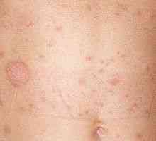 Pink zoster - fotografije, zdravljenje, povzroča kože