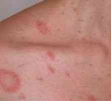 Pink zoster GIBERT - Simptomi in zdravljenje