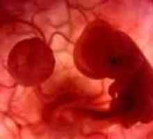Spontani splav v zgodnji nosečnosti