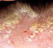 Seboroični dermatitis na glavo, zdravljenje