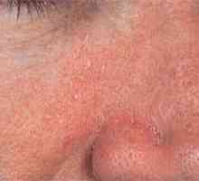 Seboroični dermatitis (ekcem mastna) obraza: vzroki, zdravljenje in preprečevanje