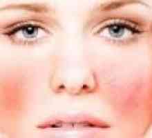 Simptomi in zdravljenje alergij na obrazu