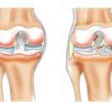 Simptomi in zdravljenje raztrganje meniskusa kolenskega sklepa