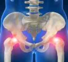 Simptomi in zdravljenje hip trohanterita