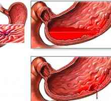 Simptomi in gastroduodenitis zdravljenje