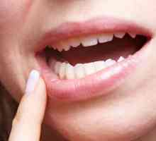 Simptomi in metode za zdravljenje ustne kandidoze