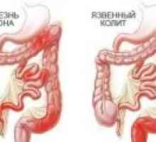 Simptomi ulcerozni kolitis