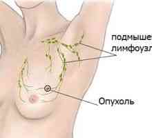 Simptomi raka na dojki
