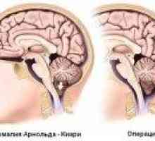 Arnold Chiari sindrom: Vzroki, simptomi, zdravljenje