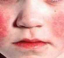 Kawasaki sindrom pri otrocih: Povzroča, diagnostike, zdravljenja