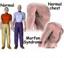 Marfanov sindrom