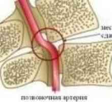 Sindrom hrbteničnega arterije v vratnih osteohondroze