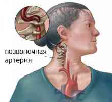 Sindrom hrbteničnega arterije v vratnih osteohondroza: simptomi, preprečevanje