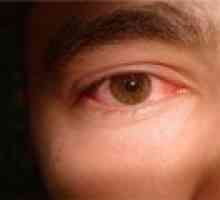 Sindrom suhega očesa - vzroki, simptomi, zdravljenje