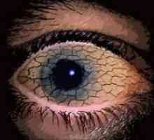 Sindrom suhega očesa