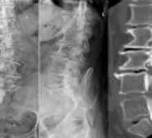 Spondilartroze ledvene hrbtenice