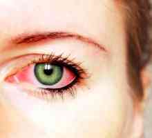 Načini zdravljenje konjunktivitisa oči