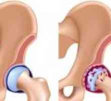 Stopnja koksartroza hip