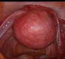 Submucous (Submukozno) materničnih fibroidov, simptomi, zdravljenje