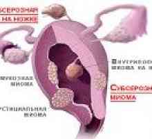 Subserous fibroidi - vzroki, simptomi, zdravljenje