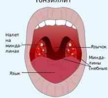 Tonzilitis