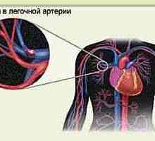 Pljučna embolija (PE)