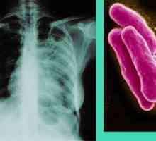 Tuberkuloza - Simptomi in znaki