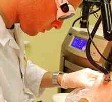 Odstranitev papilome laserja: ocene, posledice