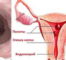Odstranitev endometrija polipi: kako ravnamo
