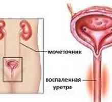 Uretritis pri ženskah - vzroki, simptomi, zdravljenje
