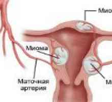 Nodularne fibroidi - vzroki, simptomi, zdravljenje
