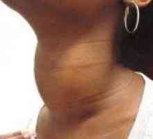 Nodularne golša ščitnice - Simptomi in zdravljenje