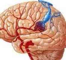 Venska angioma možganov (mali možgani, čelnega režnja)