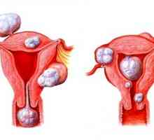 Vrste maternični fibroidi