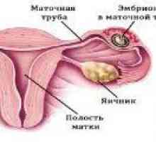 Zunajmaternične nosečnosti: simptomi, znaki, zdravljenje