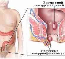Notranji hemoroidi - simptomi