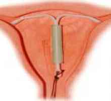 IUV kot oblika kontracepcije