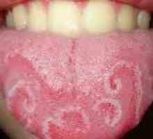 Vnetje jezika (glositis) - vzroki, diagnoza, zdravljenje