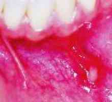 Vnetje ustne votline: vzroki, zdravljenje