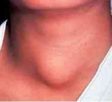 Vnetje ščitnice (tiroiditis): Simptomi in zdravljenje