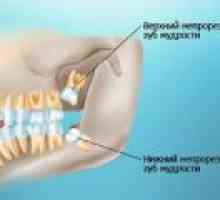 Možne posledice ko rezanje in odstranjevanje modrosti zob