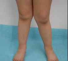 Prirojena displazija kolena