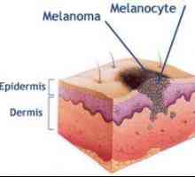 Celotna resnica o melanomu
