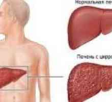 Bolezni jeter, znaki in simptomi
