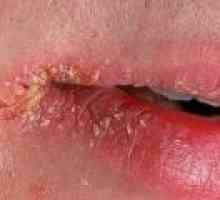 Perleches kotičke ust: simptomi, vzroki, zdravljenje